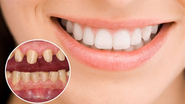 Răng sứ Vita & bảng màu răng sứ Vita phổ biến nhất hiện nay