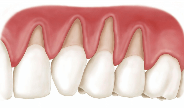 Cao răng làm tụt nướu, tiêu xương răng và rụng răng sớm