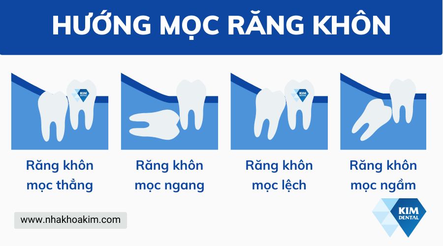 Các hướng mọc răng khôn