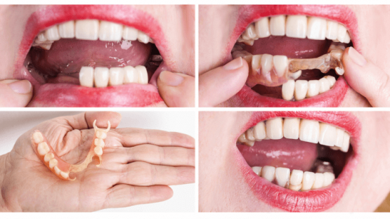 Các phương pháp làm răng giả và lưu ý quan trọng bạn nên biết