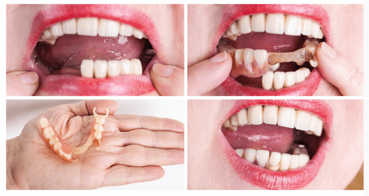 Phương pháp làm răng giả với hàm tháo lắp