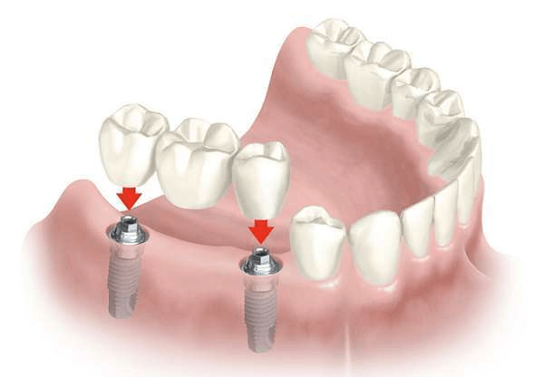 Phương pháp làm răng giả với cầu răng sứ