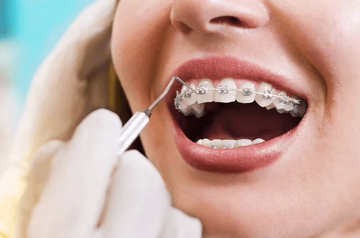 Phương pháp niềng răng mắc cài thường đem lại hiệu cao