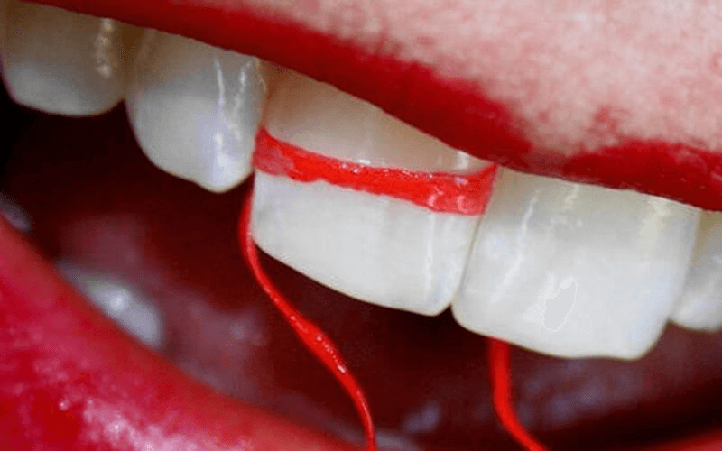 Nắn chỉnh răng tại nhà đem lại hiệu quả không cao