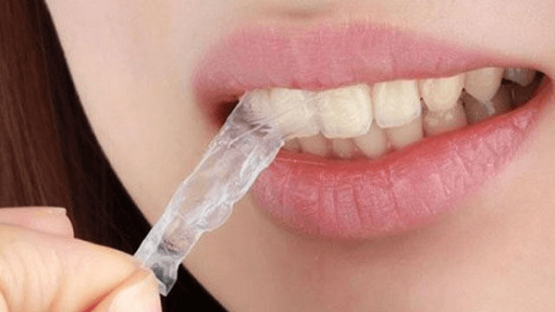 Nên thực hiện cách nắn chỉnh răng tại nhà hay đến nha khoa uy tín?