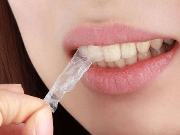 Dùng máng nhựa để chỉnh răng về đúng vị trí