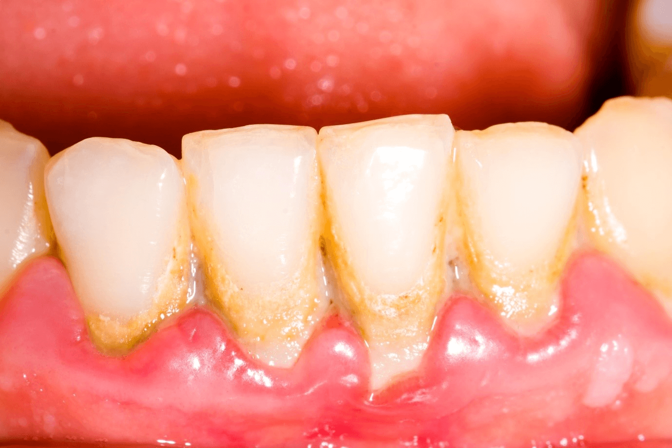 Hình ảnh thực tế của vôi răng