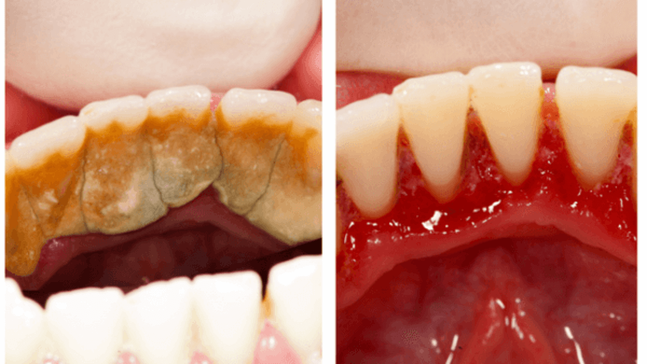 Tác hại của vôi răng gây ra cho sức khỏe