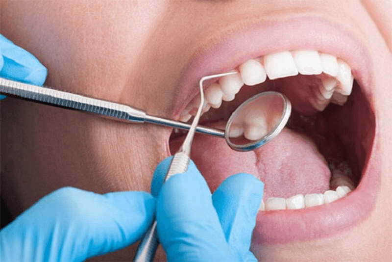 Nên lấy cao răng định kỳ từ 3 đến 6 tháng/lần