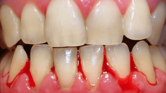 Chảy máu chân răng: Nguyên nhân và cách điều trị