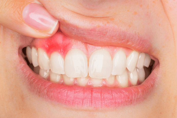 Chảy máu chân răng thường xuyên là dấu hiệu cảnh báo bệnh lý nguy hiểm