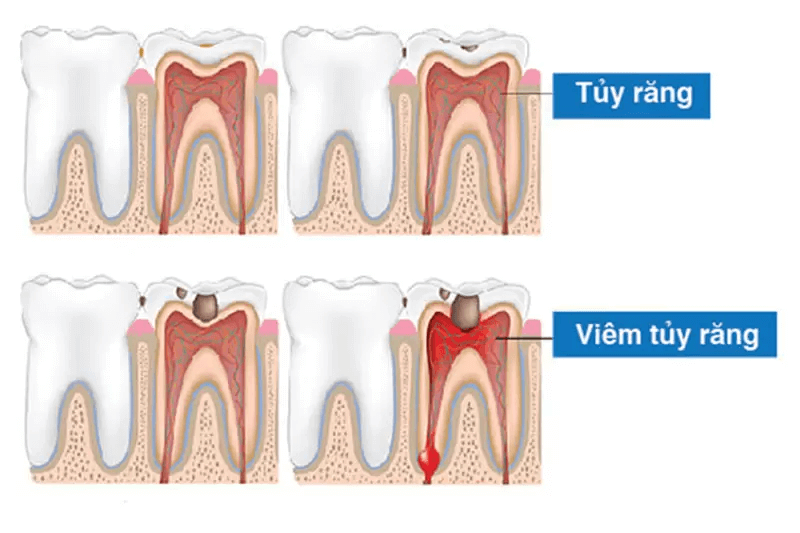 Viêm tủy răng số 7 ảnh hưởng nhiều đến sức khỏe