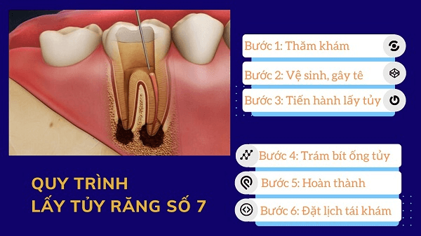 Quy trình chữa tủy răng số 7