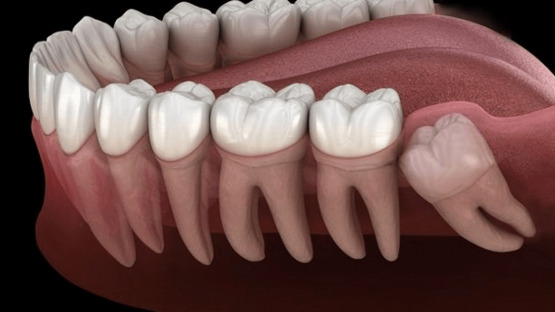 12 Triệu chứng và dấu hiệu mọc răng khôn dễ nhận biết