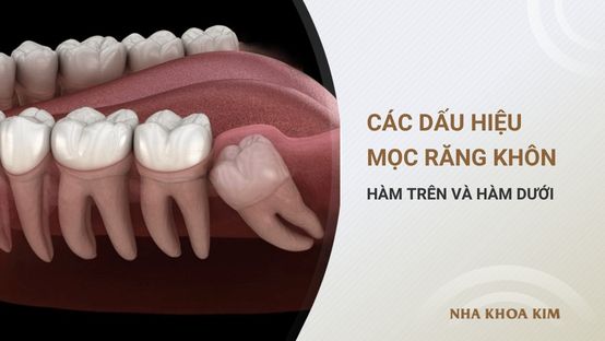Các dấu hiệu mọc răng khôn hàm trên và hàm dưới