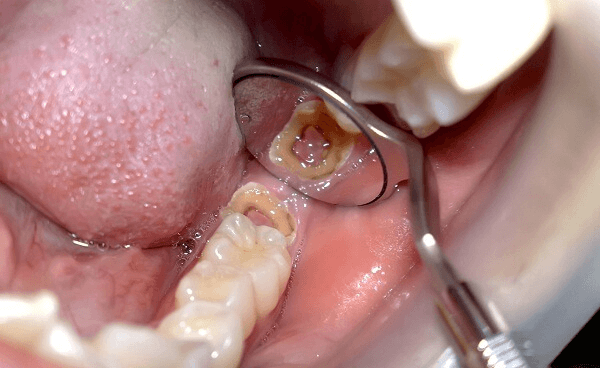 Một quá trình điều trị tủy răng mất bao lâu phụ thuộc nhiều yếu tố