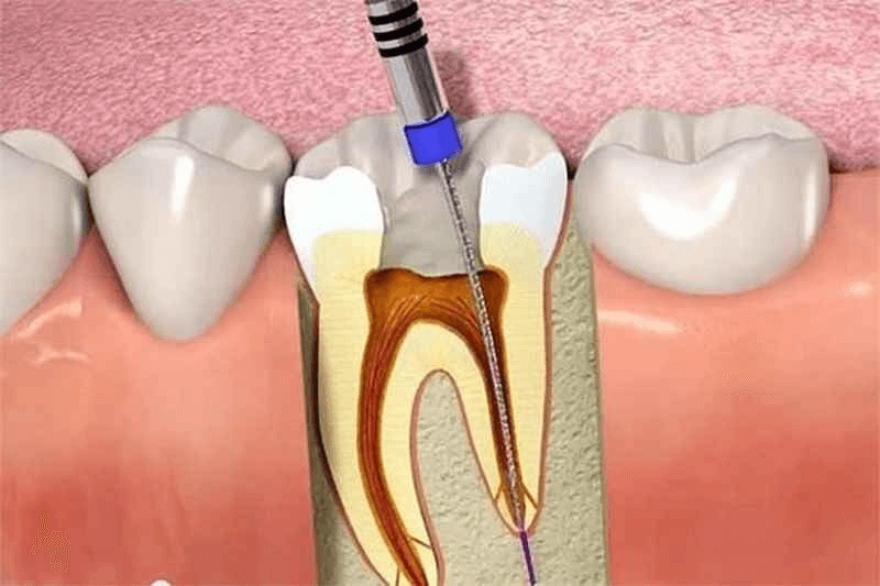 Thời gian tồn tại của răng sau lấy tủy là khoảng 15-25 năm