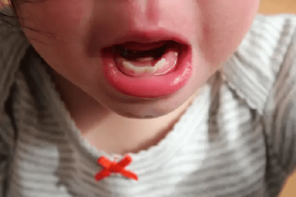 Nhận biết và điều trị viêm lợi qua hình ảnh viêm lợi ở trẻ em