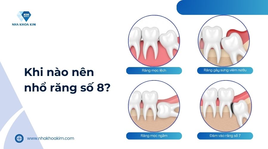 khi nào nên nhổ răng số 8?