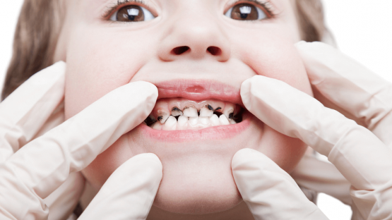 Dịch vụ làm răng giả cho trẻ em không đau tại Nha khoa Kim