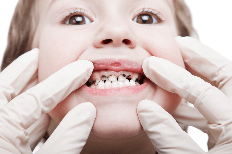 Có nên làm răng giả cho trẻ em?