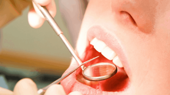 Lưu ý sau khi lấy cao răng: Nên ăn gì? Kiêng gì? Cách chăm sóc ra sao?