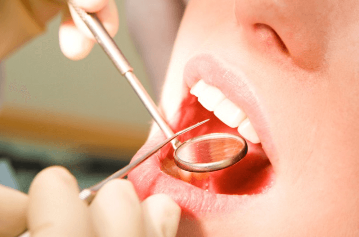 Tại sao nên lấy cao răng định kỳ?