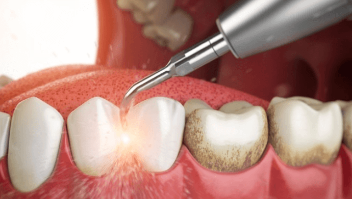 Kỹ thuật lấy cao răng bằng máy siêu âm tại Nha Khoa Kim
