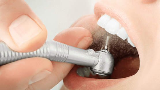 Nha Khoa Kim – Cạo vôi răng không đau bằng sóng siêu âm hiện đại