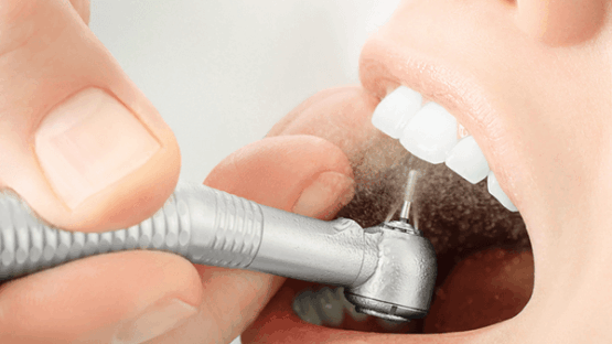 Lấy cao răng tiếng Anh là gì? Một số điều cần biết về lấy cao răng