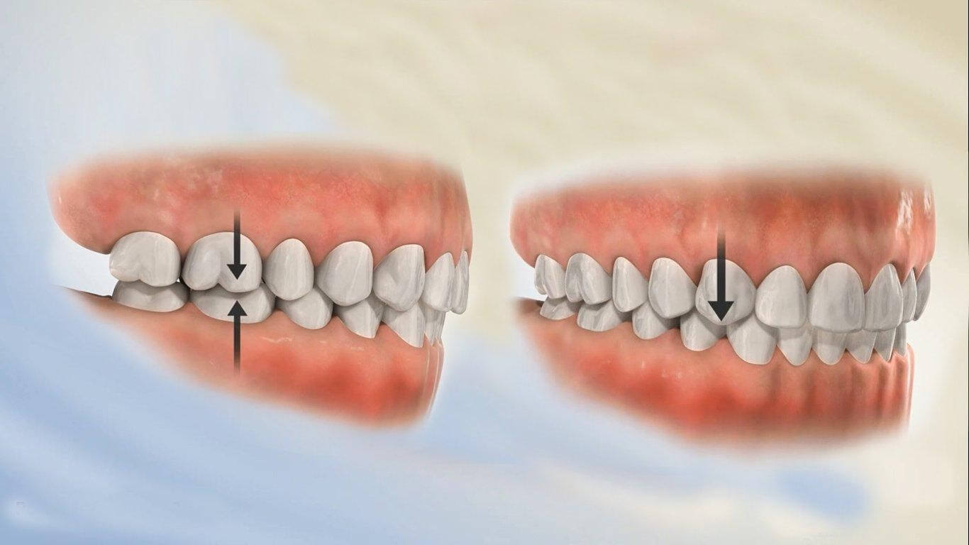 Khớp cắn sâu ảnh hưởng đến tính thẩm mỹ của hàm răng
