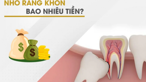 Chi phí nhổ răng khôn bao nhiêu tiền là hợp lý nhất – Nha Khoa Kim