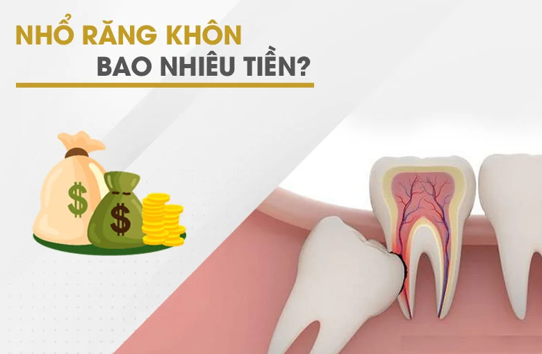 Nhổ răng khôn bao nhiêu tiền?