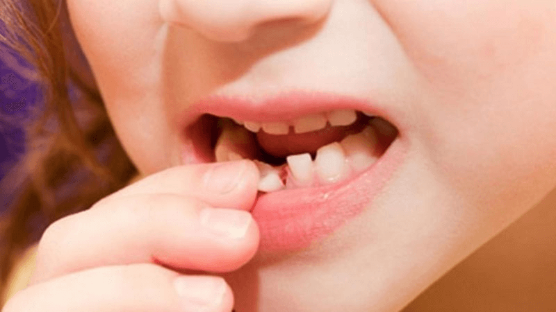 Chi phí dịch vụ nhổ răng phải chăng