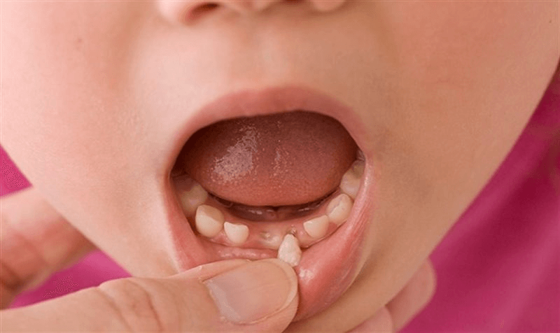 Răng mọc lẫy thường xảy ra ở trẻ trong độ tuổi 5 - 7 tuổi