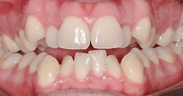 Có nên nhổ răng mọc lệch hàm trên?