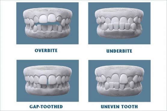 Niềng răng tiếng Anh là gì? Những thuật ngữ nha khoa thông dụng