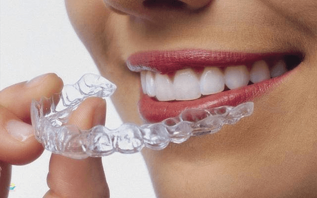 Quy trình niềng răng chuyên nghiệp tại nha khoa KIM