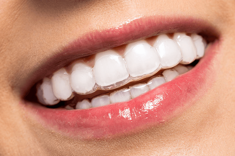 Nẹp răng trong suốt là công nghệ chỉnh nha hiện đại 