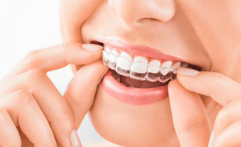 Niềng răng Zenyum là gì? Quy trình niềng răng Zenyum tại Nha Khoa Kim