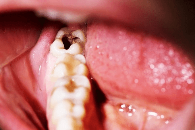 Khách hàng cần chữa trị răng tủy hàm dưới trong bao lâu?