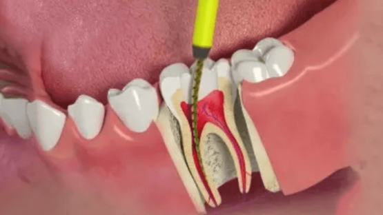 Phác đồ điều trị tủy răng an toàn, không đau tại Nha khoa Kim