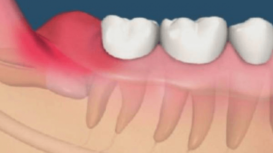 Tổng hợp các cách trị sưng nướu răng trong cùng tại nhà
