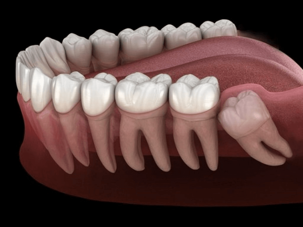 Biến chứng nguy hiểm khi răng khôn mọc lệch