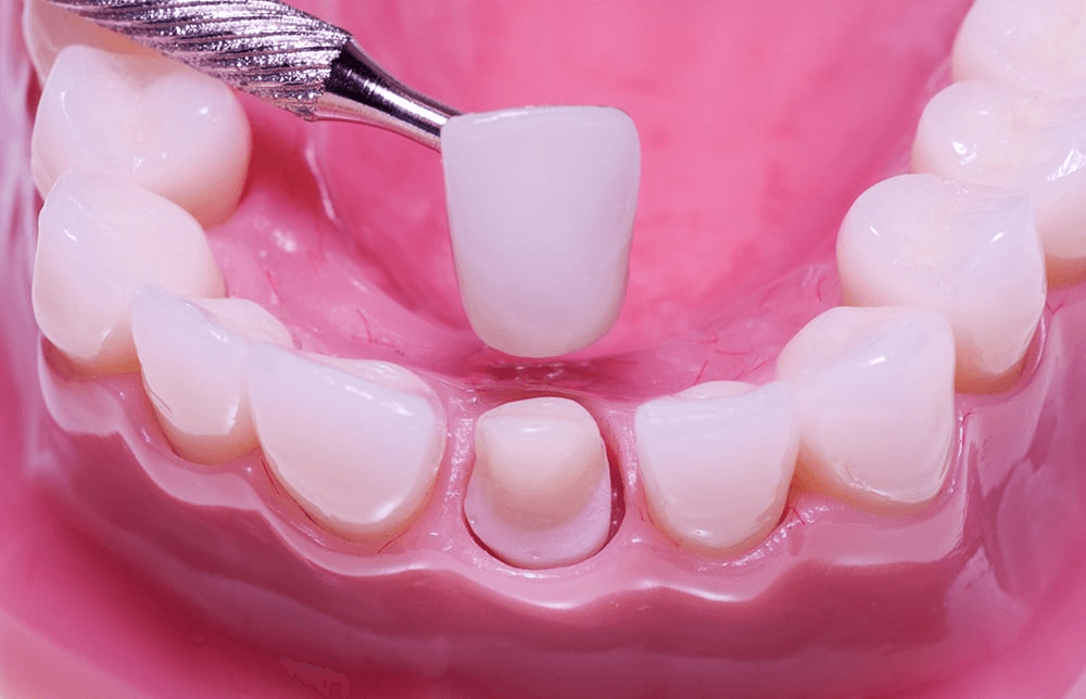 Răng sứ DDBIO là gì?