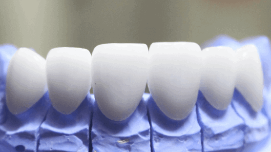 Răng sứ Ceramill Zolid giá bao nhiêu? Tìm hiểu giá tại Nha khoa KIM
