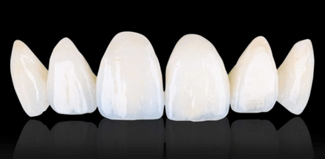 Răng sứ Cercon XT cải thiện khuyết điểm của răng sứ kim loại thông thường