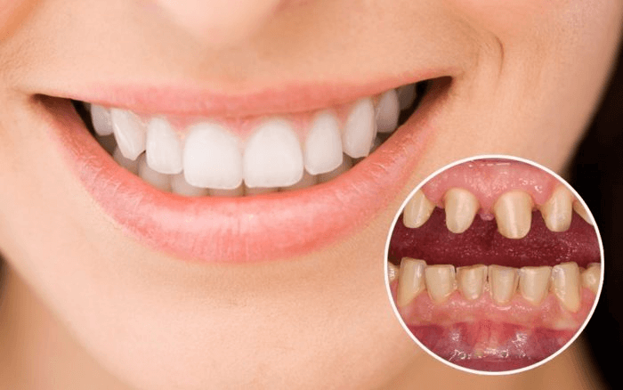 Bọc răng sứ không đau nếu thực hiện đúng kỹ thuật