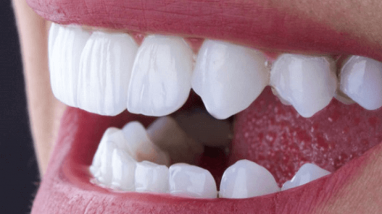 Làm răng sứ Zirconia HT chuyên nghiệp giá rẻ toàn quốc