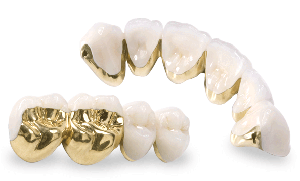 Răng sứ kim loại quý